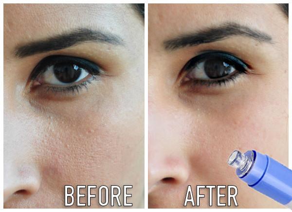 Electric Facial Pore Cleanser - Feminess