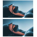Nasal Anti Snoring Device - Feminess